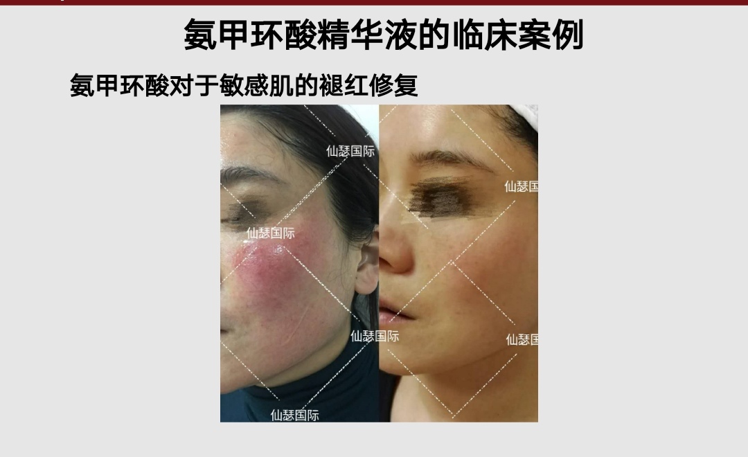 仙瑟氨甲环酸精华液效果怎么样