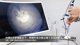 刀峰内镜-脑出血训练草稿