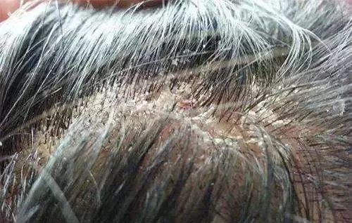 睡眠差,易生病?竟是床上螨虫成窝!用1招,亲眼看它们自投罗网