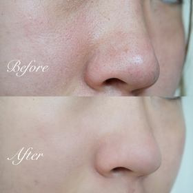 教你一招搞定黑头的办法，你确定不想知道？