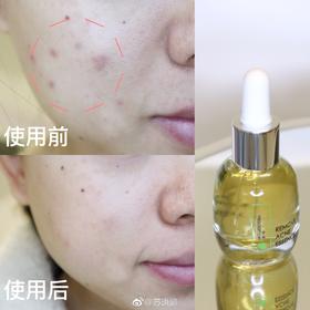 【痘肌小公主福音精华液】