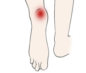 足跟痛的艾灸方法