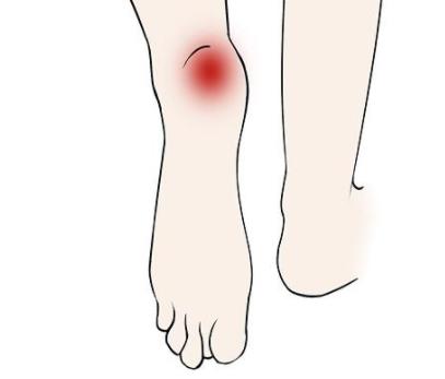 足跟痛的艾灸方法 商品图0