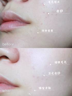 【痘肌福音，速速来看】