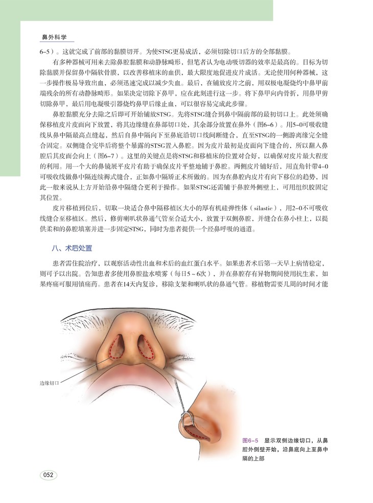 中隔成形術 第3章 內鏡下鼻中隔偏曲成形術 第4章 鼻中隔穿孔修補技術