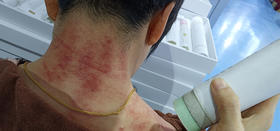 让艾灸走进千家万户