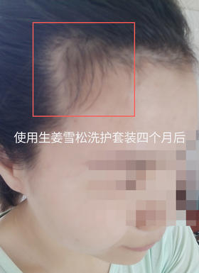 头发长出了很多，很开心！