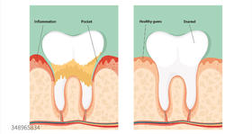  洗牙会造成牙缝变大?真相竟然是…… 