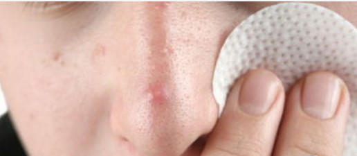 夏天痘痘更容易加重和复发，为什么？ 商品图0