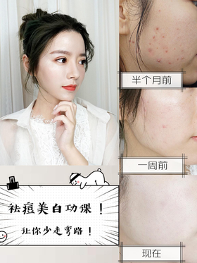 姨妈痘终于有救了！这样祛痘3天见效！