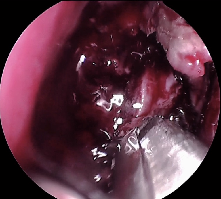 刀峰手术神经内镜镜下画面