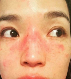 烂脸的原因，99%的人都没想到！