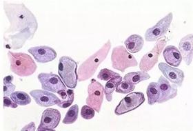  【为肠之道】慢性疾病的元凶 - 肠漏综合征 