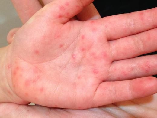 手足口病季，你需要了解这些知识 商品图0