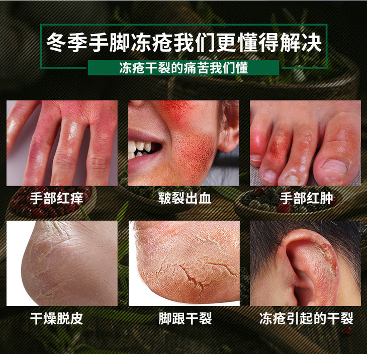 云南本草冻疮冻伤膏防冻防裂霜冻裂宝 脚后跟手裂口干裂修复霜
