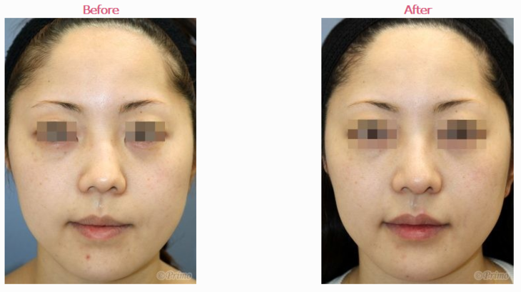 鼻中隔延长手术案例