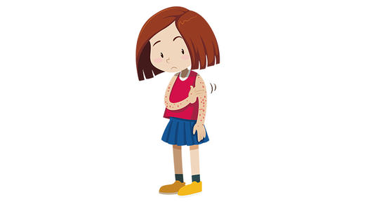 荨麻疹“来的快，去得也快”，哪些情况需要就医？ 商品图0