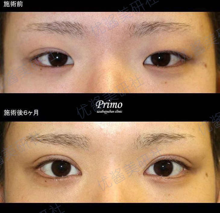 案例:眼睑下垂手术 内眼角切开