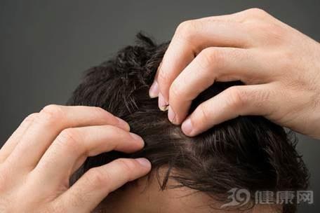 世卫组织：中国男性脱发率高达20%！该如何预防？ 商品图0