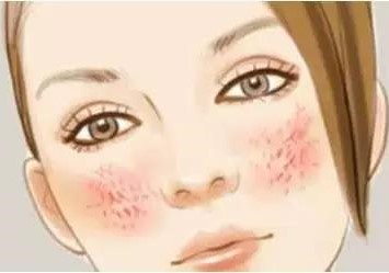 童话面膜 | 红血丝女孩要知道的护肤雷区！