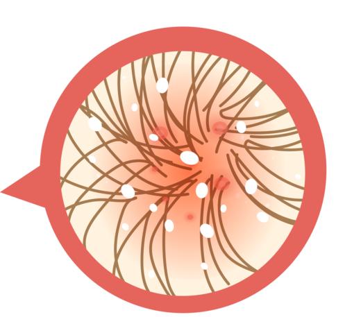 头皮出现淡红色红斑，不停搔抓怎么办？ 商品图0