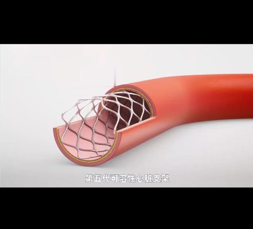 你所不知的心脏可溶性支架 商品图0