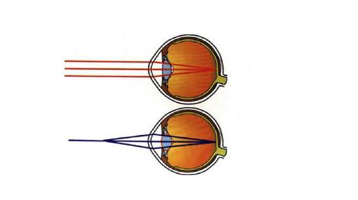 什么是屈光不正？ 商品图0