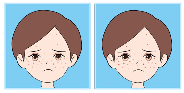  好物推荐 | 顽固痘痘毛孔粗大，这瓶堪比磨皮的网红精华带你重回颜值巅峰！ 