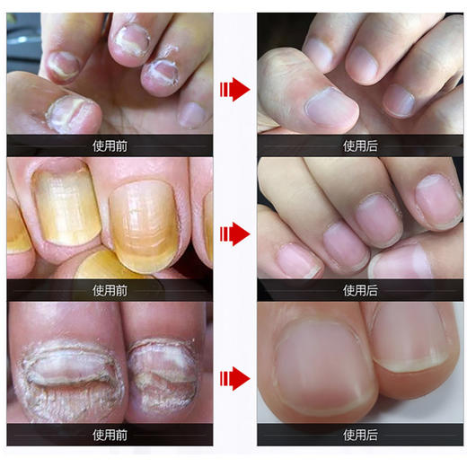草本护甲精华液 解决灰指甲亮甲等各种指甲问题 复甲油液中药去除灰指甲 商品图3