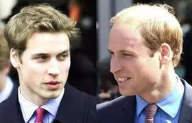  脱发、掉发的人有救了！后退的发际线重新长出来… 