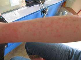  夏季过敏季，皮肤瘙痒红肿，这样做，同事惊叹犹如换皮！ 