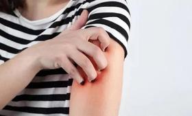  痒痒痒！夏天湿疹高发！这4个方子帮你彻底摆脱湿疹的苦恼！ 