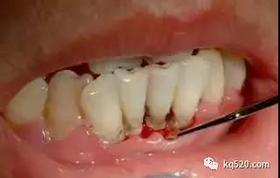  医生，我为什么牙齿容易松动？ 