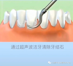  关于“洗牙 ​”的15个问题 ！涨知识 