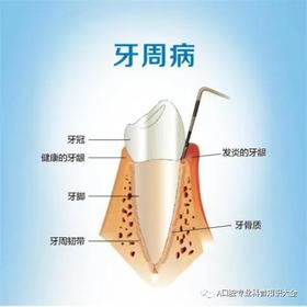  牙龈出血、口腔异味置之不理竟要做牙周治疗？究竟牙周病是什么？ 