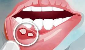  口腔溃疡’反复发作？ 超过这个时间，当心癌症找上门.... 