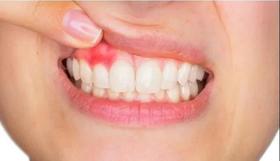  牙齿有这“4种情况”会反复发炎，吃啥药都不会管用？ 