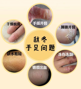  秋冬换季手脚干裂、脱皮、冻疮怎么办？