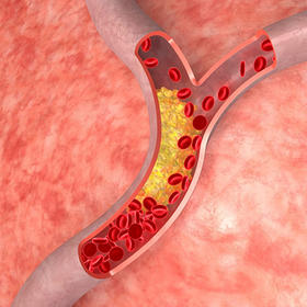  你必须要知道的知识：动脉硬化不是动脉粥样硬化 