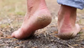  牛，太牛了！折磨2000万人的脚裂问题，终于被仁和药企攻克了！ 