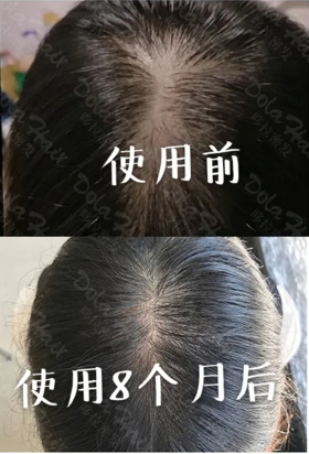  反馈 | 使用MAX1套装2个月见效，8个月发量翻倍！ 