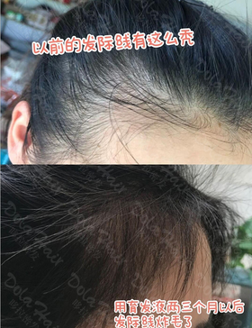  密友反馈 | 她用了一款更省钱的套装，6个月就实现了发量翻倍！ 