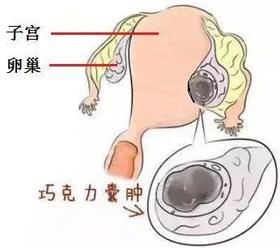  浪漫名字背后的狰狞-巧克力囊肿，不死的癌症（五）！ 