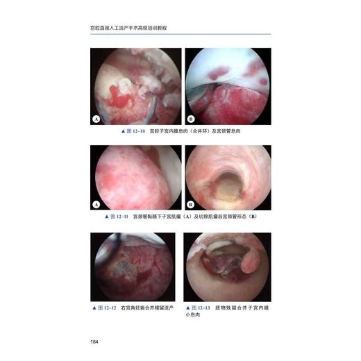 宫腔直视人工流产手术高级培训教程 商品图3
