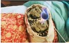 三九贴+三九灸套餐 商品缩略图2
