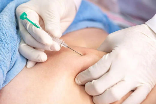 中医穴位埋线 商品图0