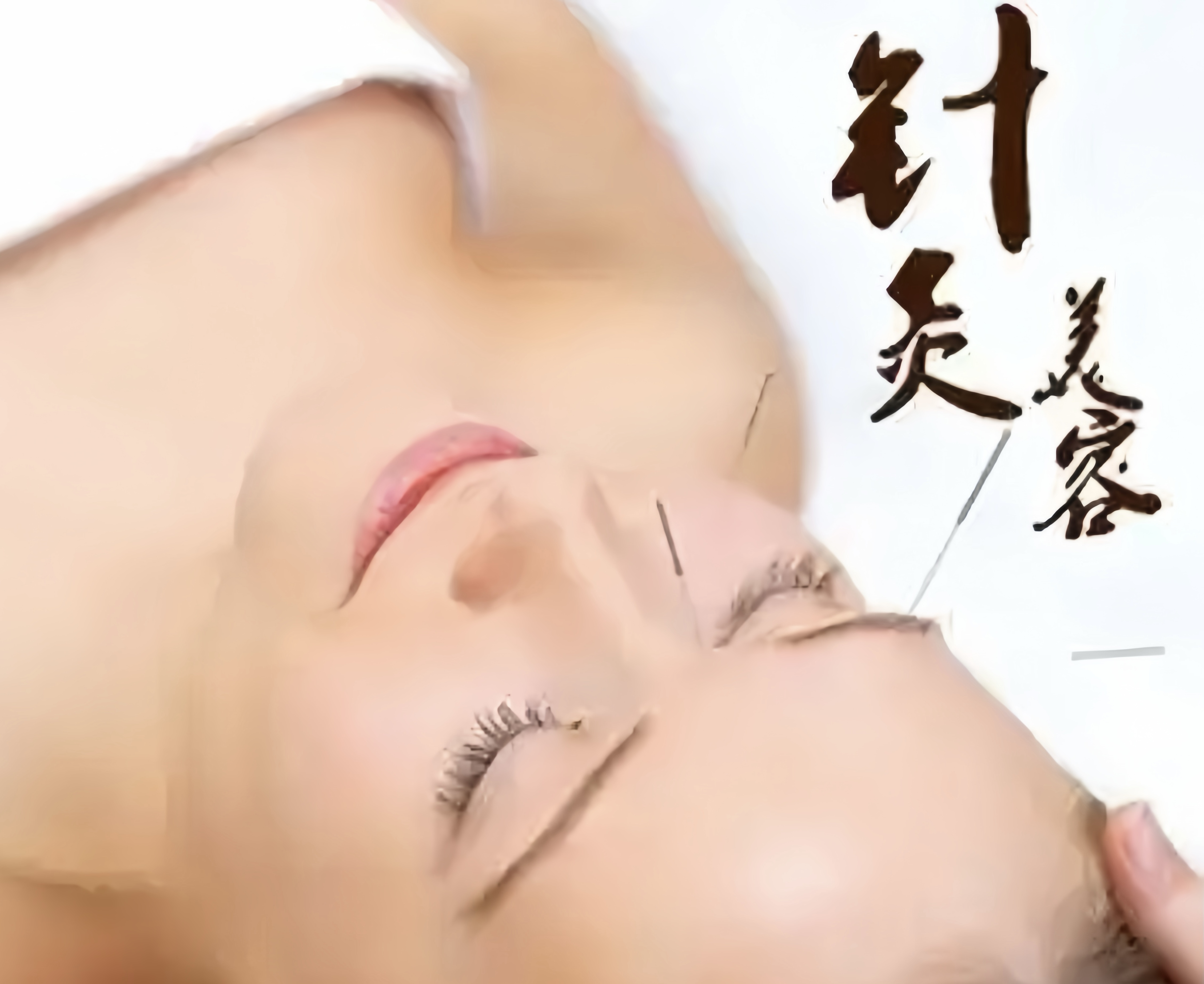 中医针灸【面部针灸】