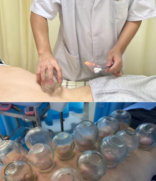 中医拔罐 1次（仅到兴华社卫使用） 商品图0