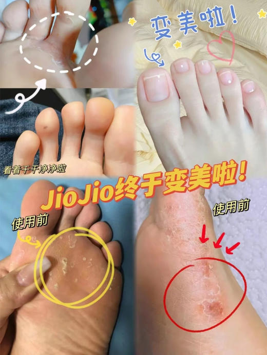 🔥香港宝芝林出品狼毒草本清脚气保健膏-  最 商品图3