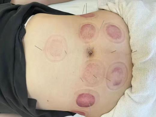 中医调理针灸 （仅到兴华社卫使用） 商品图0